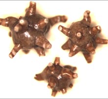 Sparacino-kidney-stones